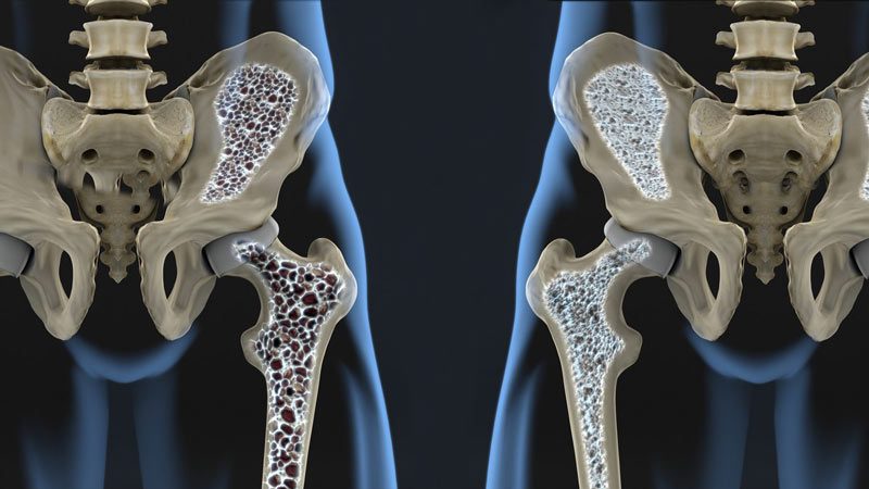 How Do You Know If Your Osteoporosis Is Getting Worse H1: Introduction Osteoporosis is a common condition characterized by the weakening of bones, making them fragile and more susceptible to fractures. As individuals age, the risk of osteoporosis and its potential progression becomes a significant concern. However, understanding whether your osteoporosis is getting worse and knowing the signs to look out for can help you take proactive steps to manage and improve your bone health. In this comprehensive guide, we will explore the key indicators that suggest your osteoporosis may be worsening, the factors influencing its progression, and strategies to monitor and address this condition effectively. H2: Understanding Osteoporosis Progression What Is Osteoporosis? Osteoporosis is a bone disease characterized by a reduction in bone density and quality. Bones become porous and brittle, increasing the risk of fractures, especially in areas such as the hips, spine, and wrists. While osteoporosis is often associated with aging, it can affect individuals of all ages and genders. Factors That Influence Osteoporosis Progression Several factors can influence the progression of osteoporosis, including: Age: Aging is a primary risk factor for osteoporosis. As you get older, your bone density naturally decreases. Hormones: Hormonal changes, such as menopause in women, can lead to bone loss. Reduced estrogen levels can accelerate bone weakening. Nutrition: Inadequate intake of calcium and vitamin D can compromise bone health. These nutrients are essential for maintaining strong bones. Physical Activity: A sedentary lifestyle or lack of weight-bearing exercises can contribute to bone loss. Medications and Health Conditions: Certain medications and health conditions can impact bone health. For example, long-term use of corticosteroids and medical conditions like rheumatoid arthritis can increase the risk of osteoporosis. H3: Signs That Your Osteoporosis May Be Worsening 1. Increased Fracture Risk One of the most apparent signs that your osteoporosis may be worsening is an increased risk of fractures. If you experience fractures more frequently, especially in common osteoporotic fracture sites like the hip, spine, and wrist, it's a clear indication that your bone health is deteriorating. 2. Loss of Height Osteoporosis can lead to a reduction in height over time due to vertebral compression fractures. If you notice a significant decrease in your height or a stooped posture, it may signal the progression of the condition. 3. Persistent Back Pain Chronic back pain, especially in the lower back, can be a symptom of vertebral fractures caused by osteoporosis. If you have persistent and unexplained back pain, it's essential to consult a healthcare professional for evaluation. 4. Decline in Bone Density Regular bone density scans, often conducted using dual-energy X-ray absorptiometry (DXA), can reveal changes in bone density over time. If your bone density continues to decline in subsequent scans, it suggests worsening osteoporosis. H3: Frequently Asked Questions (FAQs) H4: Can osteoporosis be reversed or cured? Osteoporosis is a chronic condition that cannot be completely reversed or cured. However, it can be effectively managed through lifestyle changes, medications, and proactive measures to prevent fractures and slow down bone loss. H4: How often should I have bone density scans to monitor osteoporosis progression? The frequency of bone density scans depends on individual risk factors and your healthcare provider's recommendations. Generally, it is recommended to have a baseline scan after menopause or at age 65 for women and at age 70 for men. Subsequent scans are typically done every 1-2 years. H4: What lifestyle changes can help manage and slow down osteoporosis progression? Lifestyle changes that can help manage and slow down osteoporosis progression include: Diet: Ensure a calcium-rich diet and adequate vitamin D intake. Exercise: Engage in weight-bearing and strength-training exercises regularly. Smoking and Alcohol: Quit smoking and limit alcohol consumption. Medications: If prescribed, take osteoporosis medications as directed by your healthcare provider. H2: Monitoring and Managing Osteoporosis Regular Bone Density Scans Bone density scans, as mentioned earlier, are essential for monitoring the progression of osteoporosis. These scans can detect changes in bone density and help assess the effectiveness of treatment and lifestyle modifications. Medications In some cases, healthcare providers may prescribe medications to manage osteoporosis and reduce the risk of fractures. These medications work by either slowing down bone resorption (breakdown) or promoting bone formation. It's essential to take these medications as directed and discuss any concerns or side effects with your healthcare provider. Lifestyle Modifications Adopting a bone-healthy lifestyle is crucial for managing and slowing down the progression of osteoporosis. This includes: Diet: Ensure you have a balanced diet rich in calcium and vitamin D. Exercise: Engage in weight-bearing and resistance exercises to strengthen bones and muscles. Quit Smoking: If you smoke, quitting is vital for bone health. Limit Alcohol: Limit alcohol consumption, as excessive alcohol can weaken bones. Prevent Falls: Take measures to prevent falls, such as removing tripping hazards at home and using assistive devices if needed. Consulting with Healthcare Providers Regular communication with your healthcare provider is essential for managing osteoporosis effectively. They can assess your condition, adjust treatment plans as needed, and provide guidance on lifestyle modifications. H1: Conclusion how do you know if your osteoporosis is getting worse