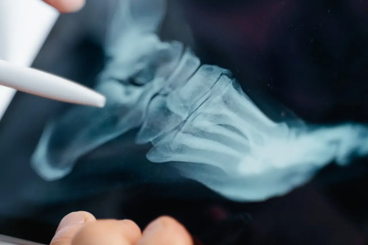 At What Age Is It Too Late to Have Bunion Surgery?